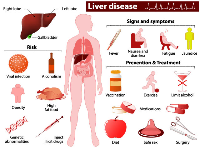 Common signs, symptoms, prevention, and treatment for liver disease.